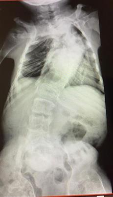 Outcome of COVID19 in Patients With Osteogenesis Imperfecta: A Retrospective Multicenter Study in Saudi Arabia